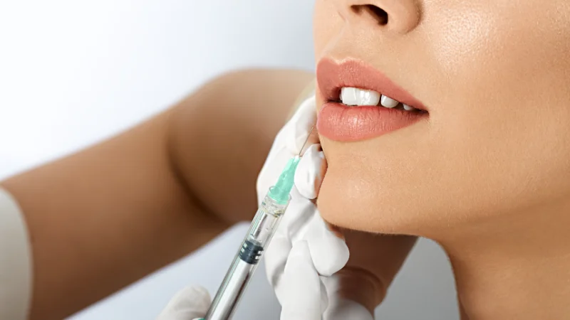 Lip Augmentation Results Achieving a Balanced Appearance