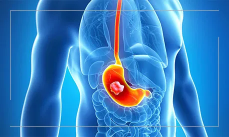 ayurvedic remedies for gastritis